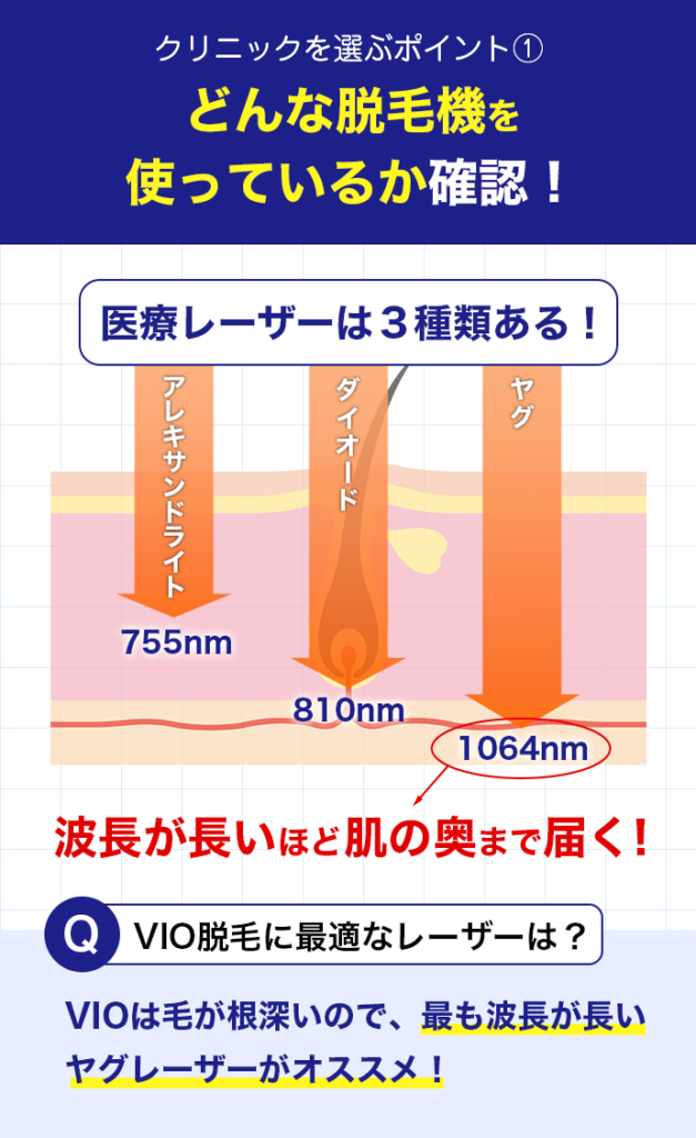 医療脱毛のレーザーの種類を表す画像