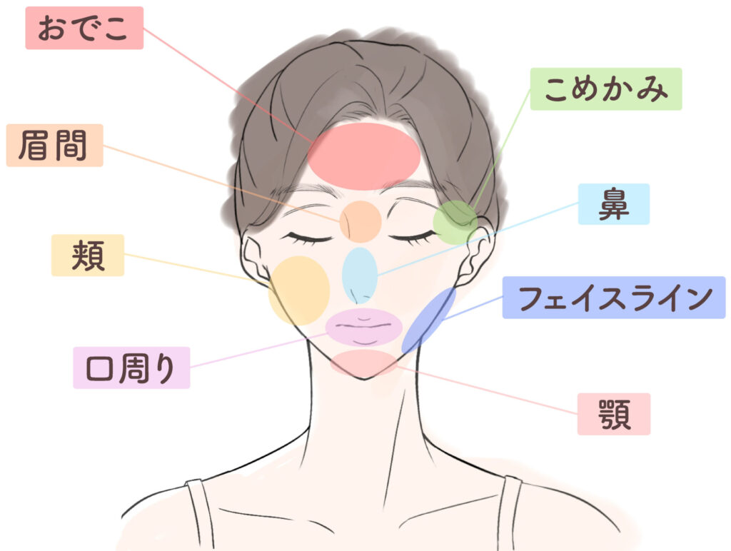 ニキビマップの画像