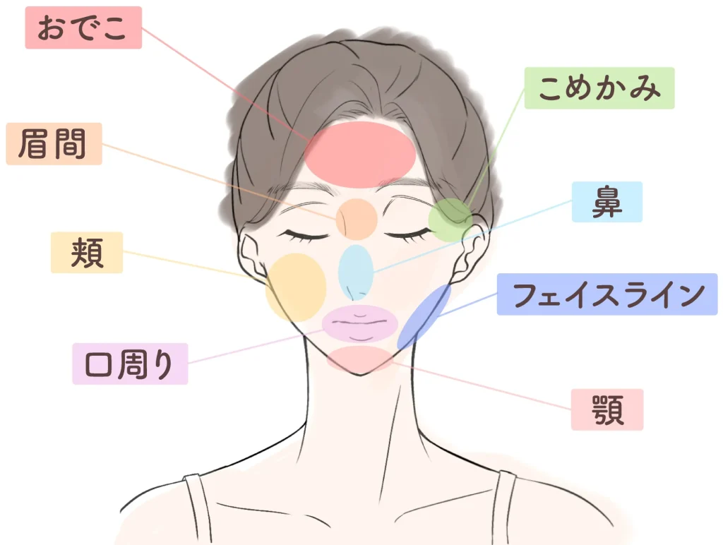 ニキビマップの画像